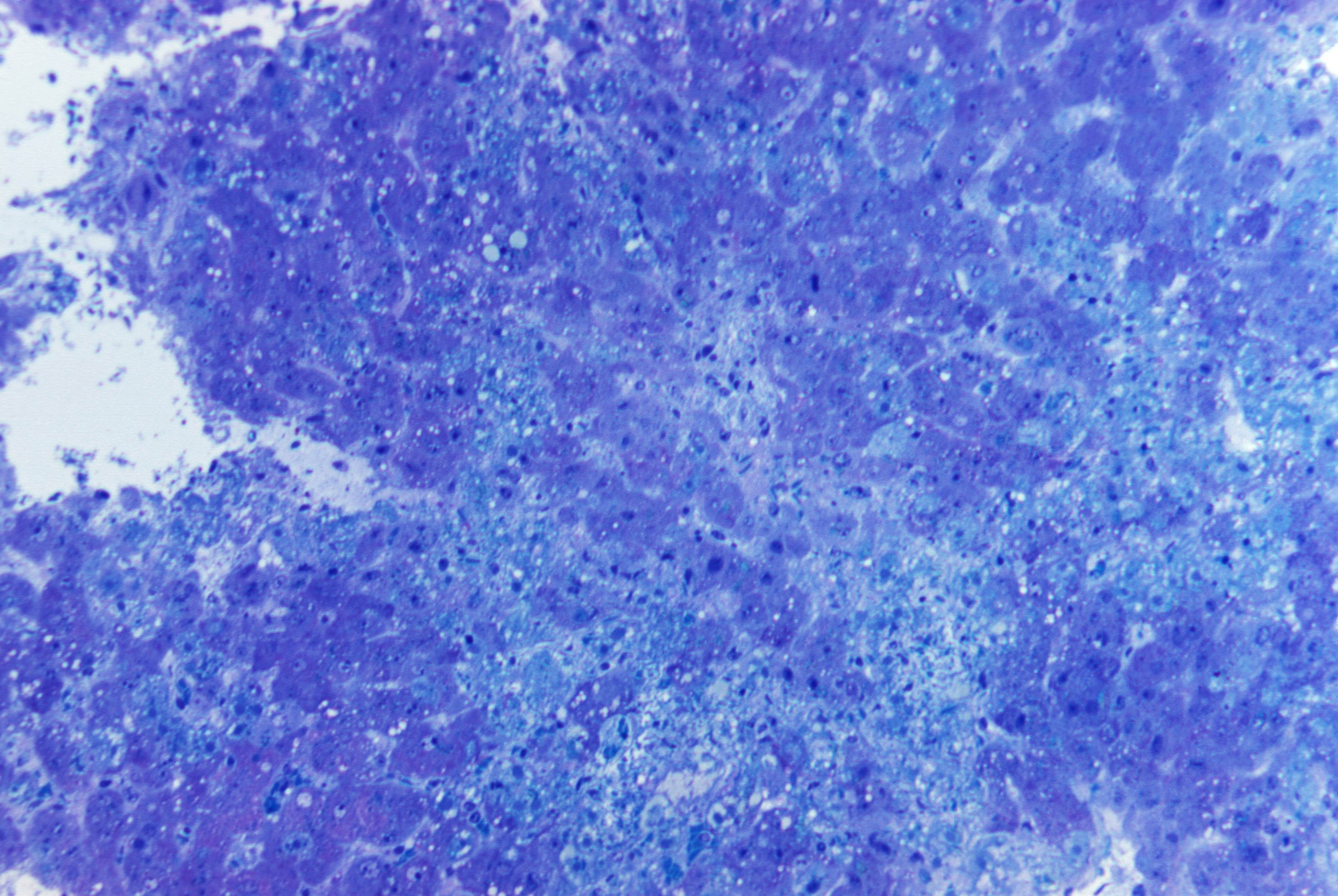 Lassa hemorrhagic fever Lassa virus free image, public domain image