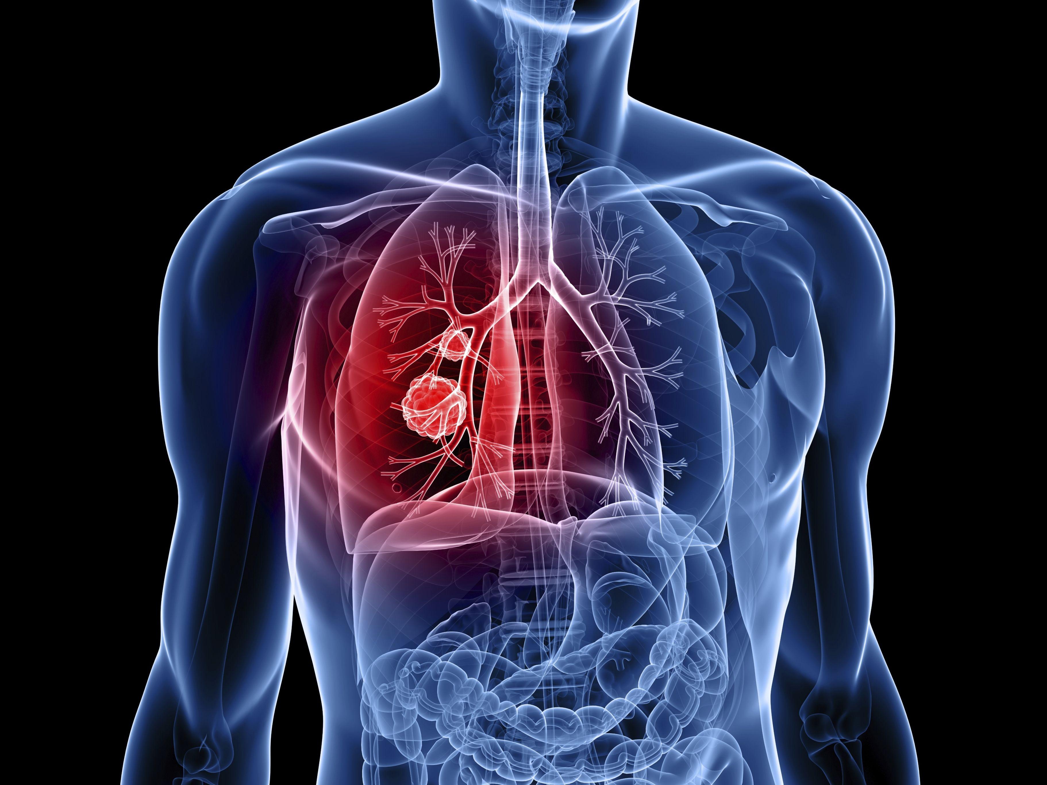 Lung cancer: 7 breakthroughs in research, treatment, diagnosis
