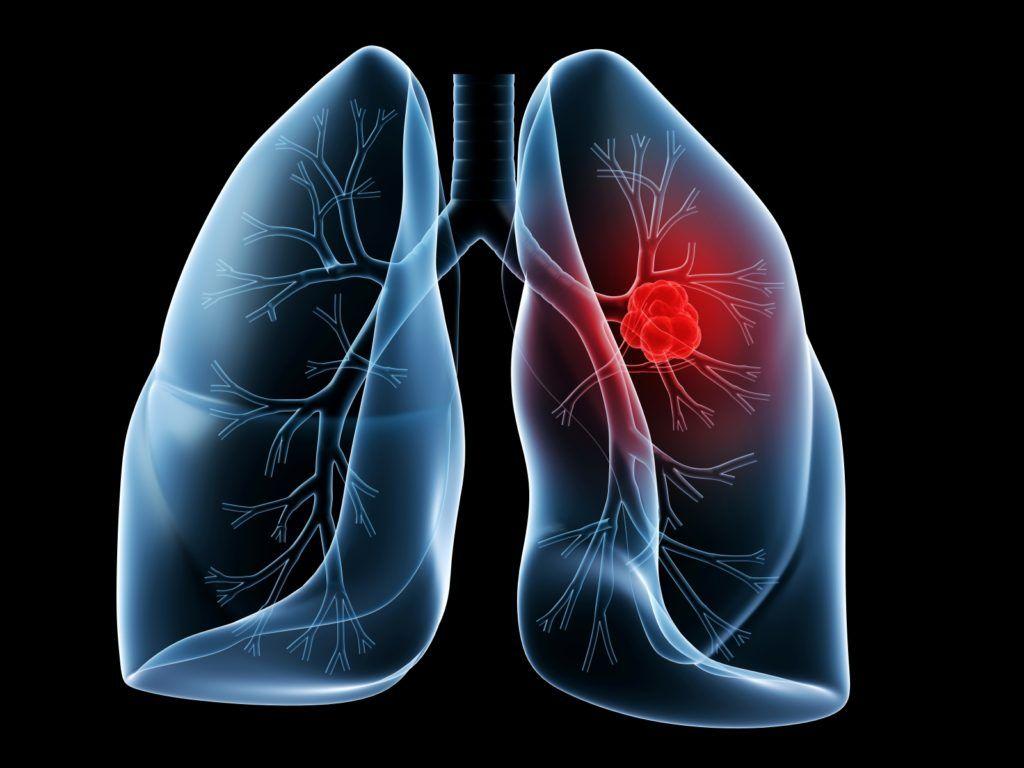 Lung Cancer Signs and Symptoms. Different Stages of Lung Cancer