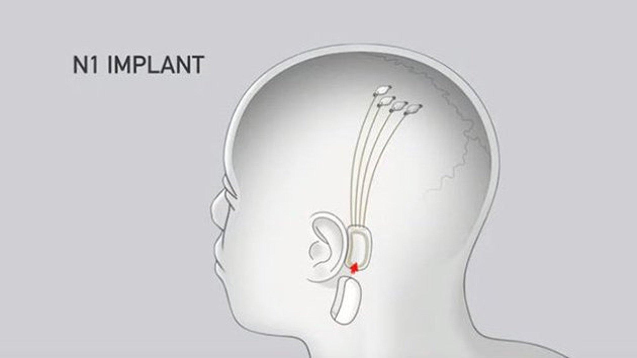Elon Musk Backed Neuralink Unveils Brain Implant Technology