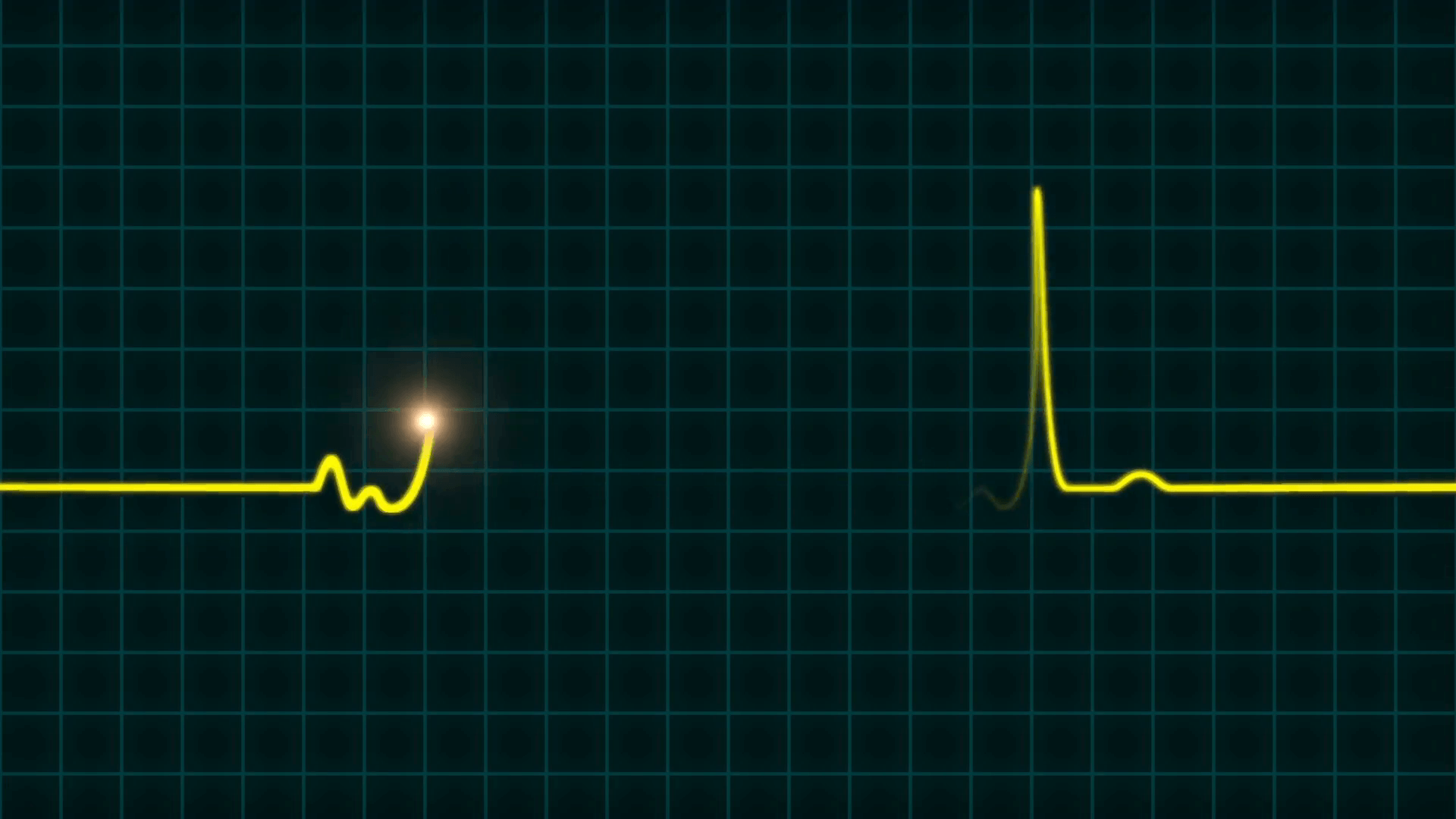 An animated EKG heartbeat monitor in yellow wave line (two beat). Audio is included. Full HD footage Motion Background