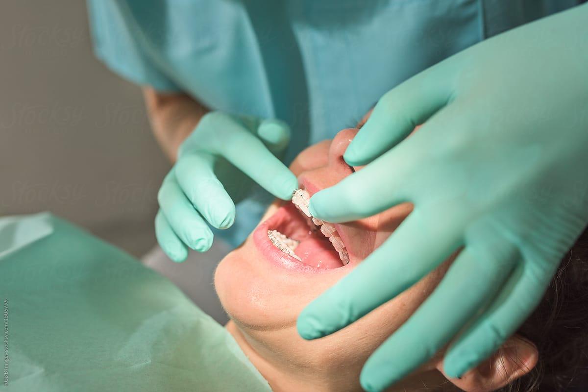 Detail shot of dentist fixing dental braces to patient