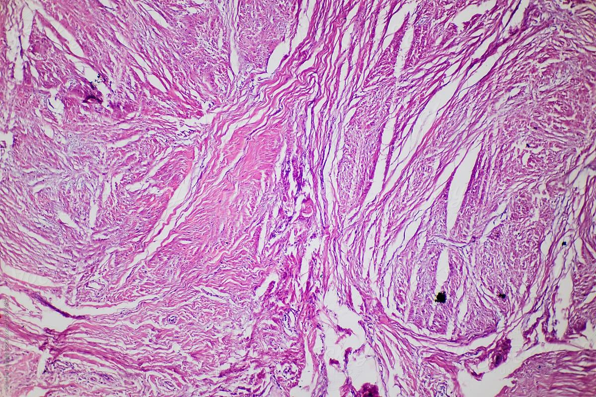 Connective tissue hyaline degeneration of human