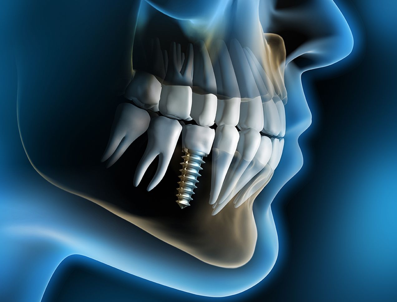 Dental Implants And Prosthetics