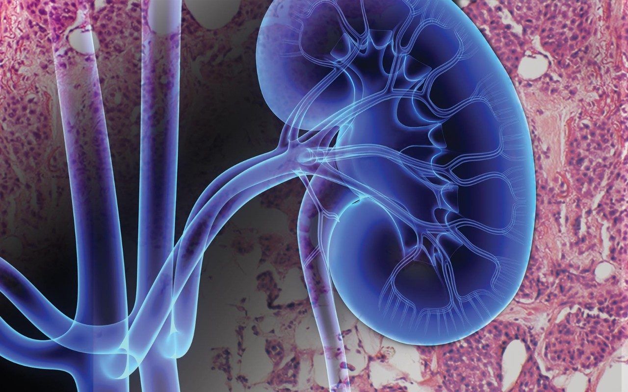 Immunotherapy Combo Shows Promise For Kidney Cancer Cancer