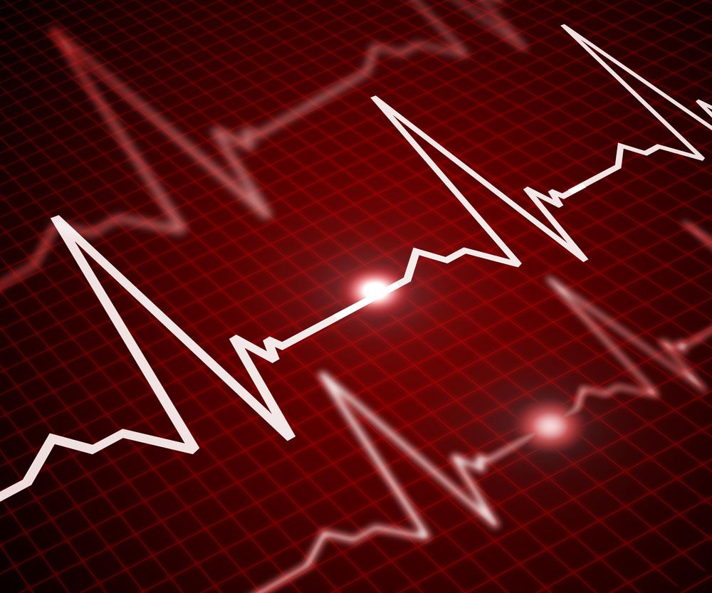 Unsteady Heartbeat Could Spell Early Dementia