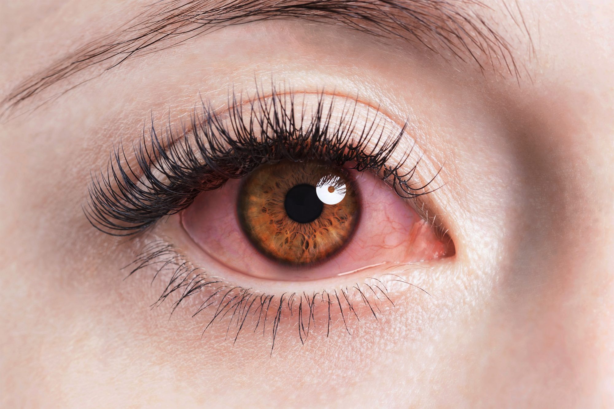 What Eye Freckles Can Tell You About Your Health