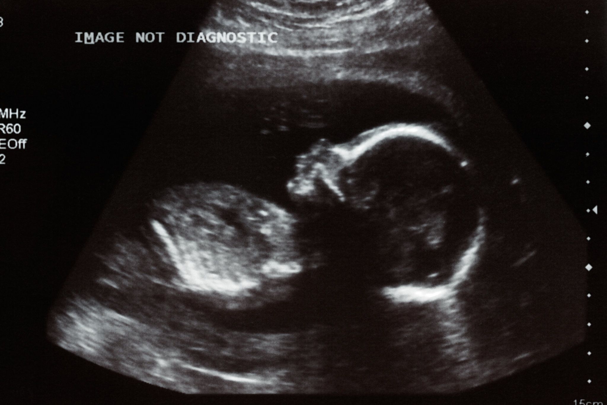 Baby Was Infected With Coronavirus in Womb, Study Reports