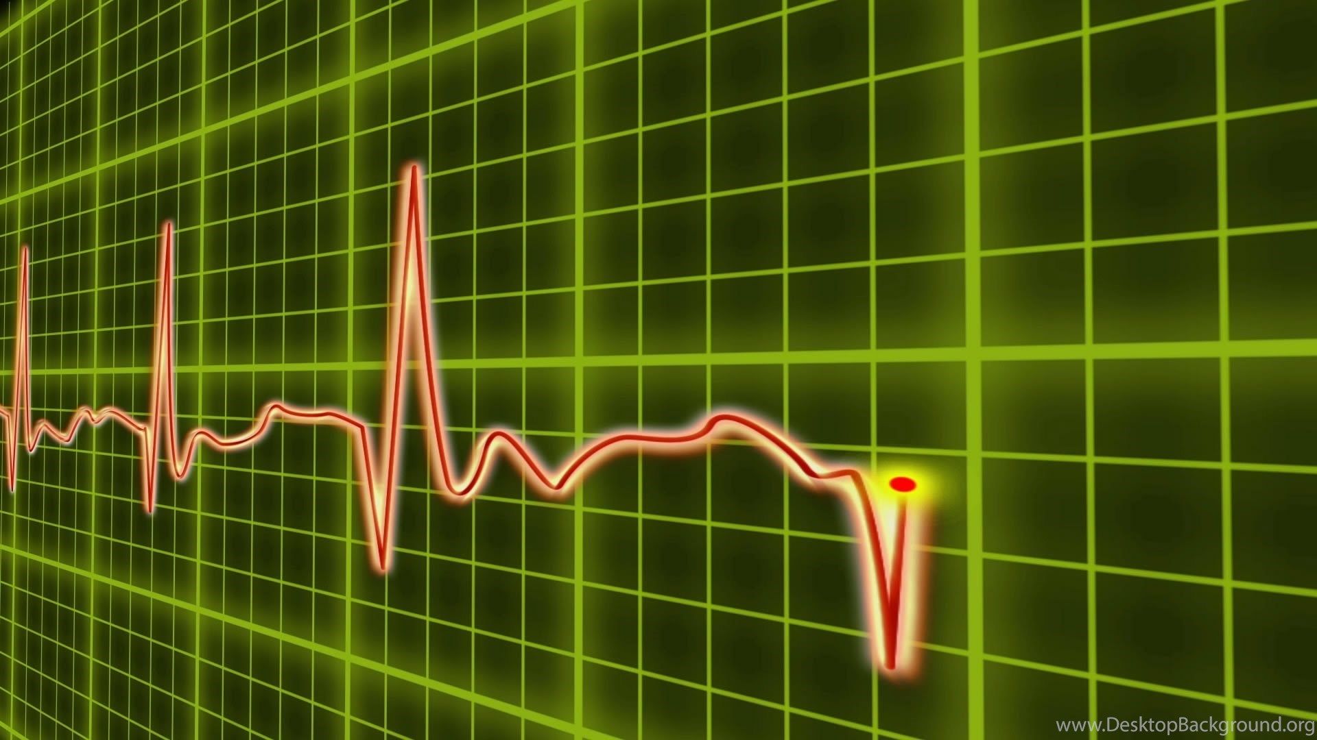 EKG Cardio Heart Beat, Normal And Zero Pulse With Audio. Stock. Desktop Background