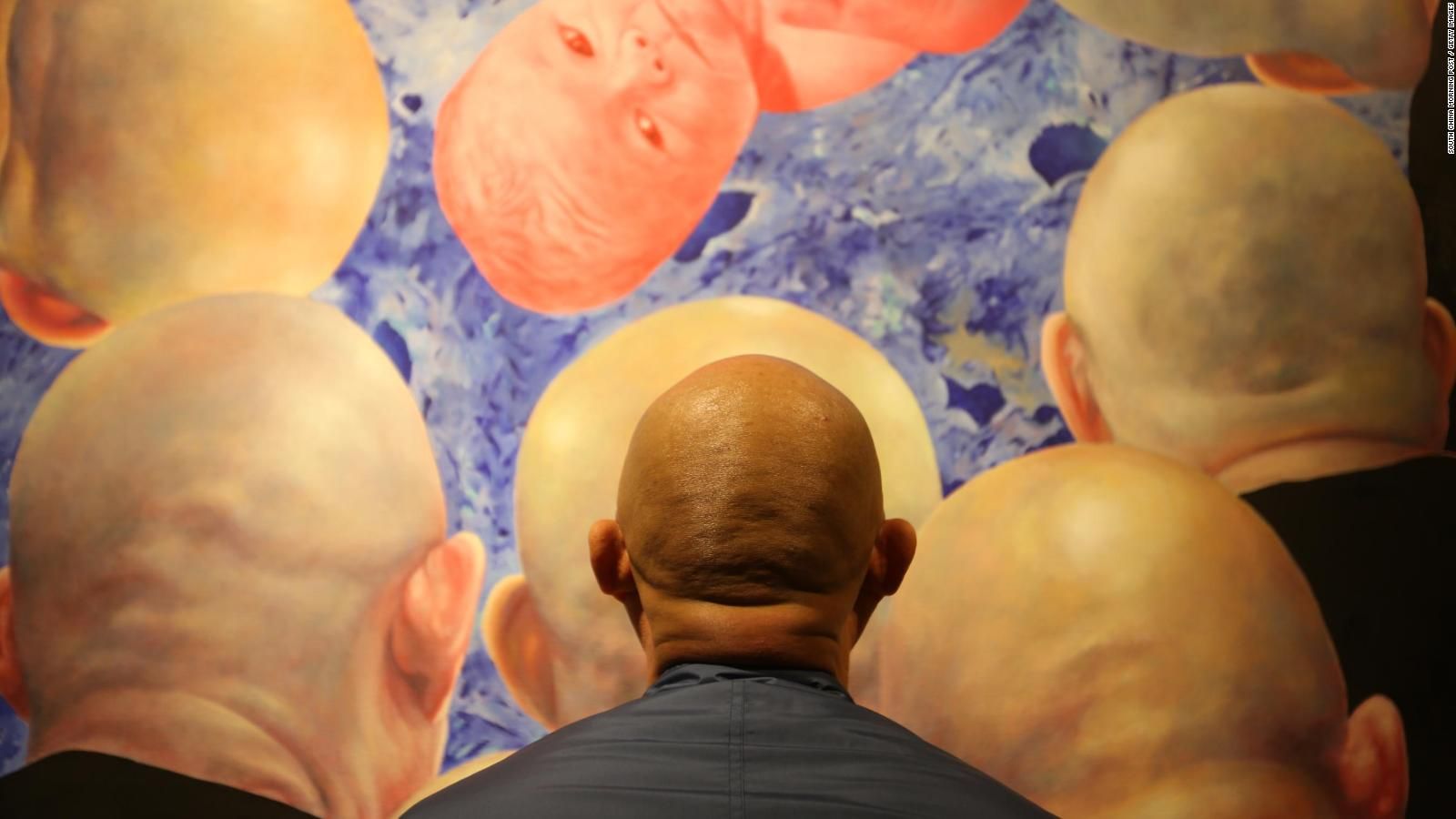 As hair loss rises, bald men in Asia grapple with cultural stigmas