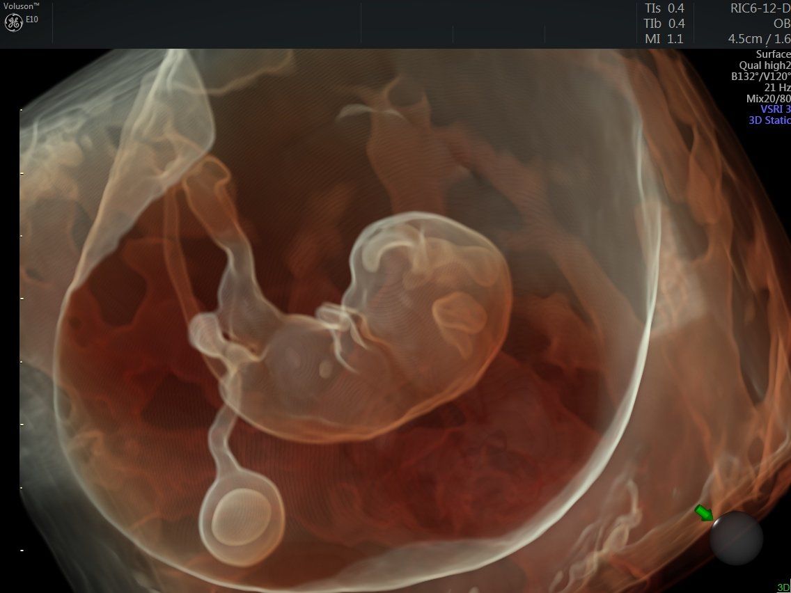 Fetal Ultrasound Image Gallery. Fetal Picture of Ultrasound